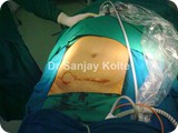 incisional hernia 1c